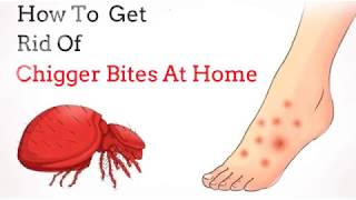 how to get rid of chigger bites
