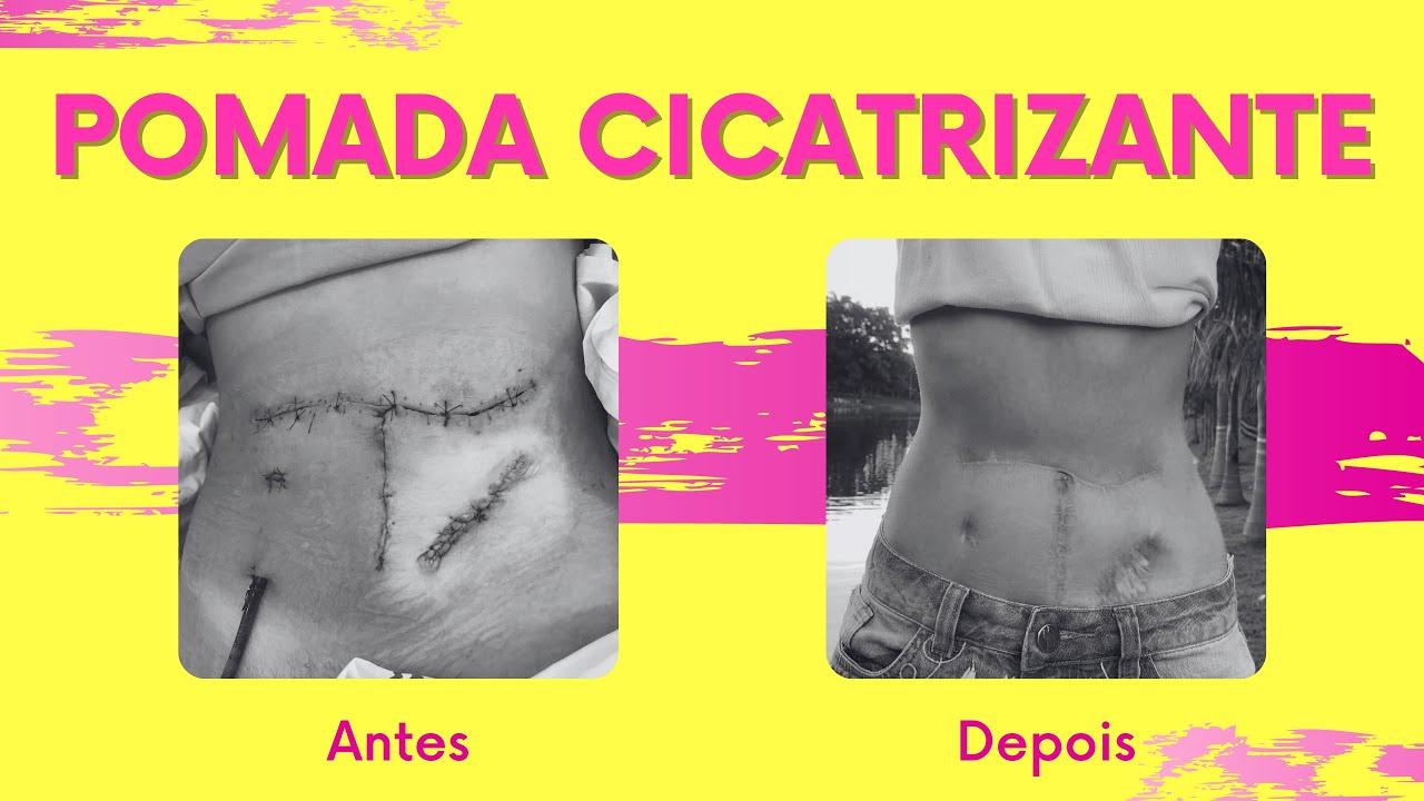 Como clareei as minhas cicatrizes | POMADA PARA CLAREAR CICATRIZES
