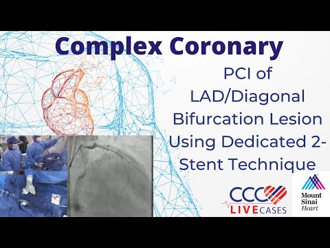 Staged PCI of RCA CTO via Antegrade or Retrograde Approach