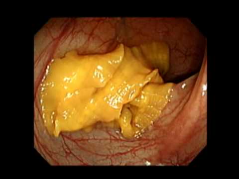 Diphyllobothrium Latum During Colonoscopy