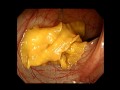 Live Diphyllobothrium Latum during Colonoscopy | NEJM
