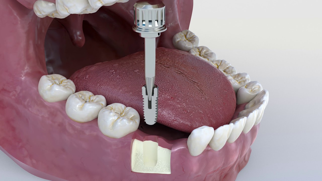 GMI implants extractor.