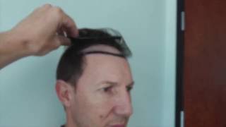 Natural Hair Transplants | Hair Transplant Surgery USA
