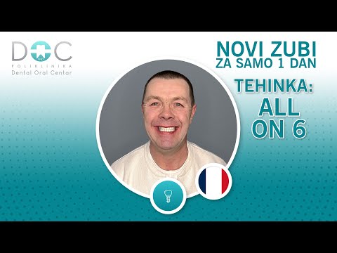 Tehnika All On 6 - Novi zubi za samo 1 dan - Dental Oral Centar