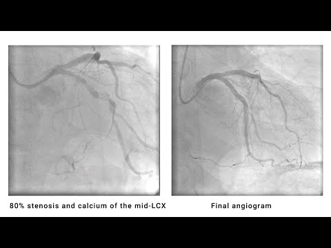 Exceptional crossability in heavily calcified lesion
