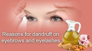 Reasons for dandruff on eyebrows and eyelashes - Onlymyhealth.com
