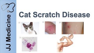 Cat Scratch Disease  Causes Symptoms and Treatment
