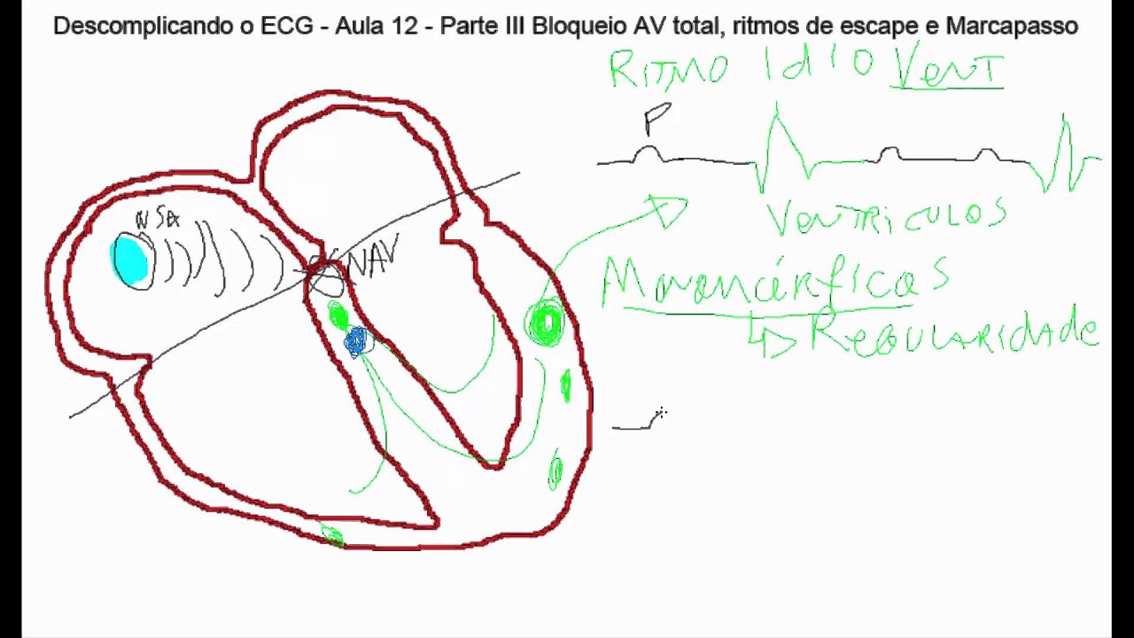 Descomplicando o ECG - Aula 12 parte 3 -  (BAVT), Ritmo de escape, e Marca-passo
