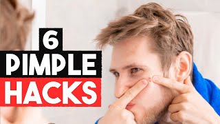 6 Hacks To Get Rid of Pimples Quickly
