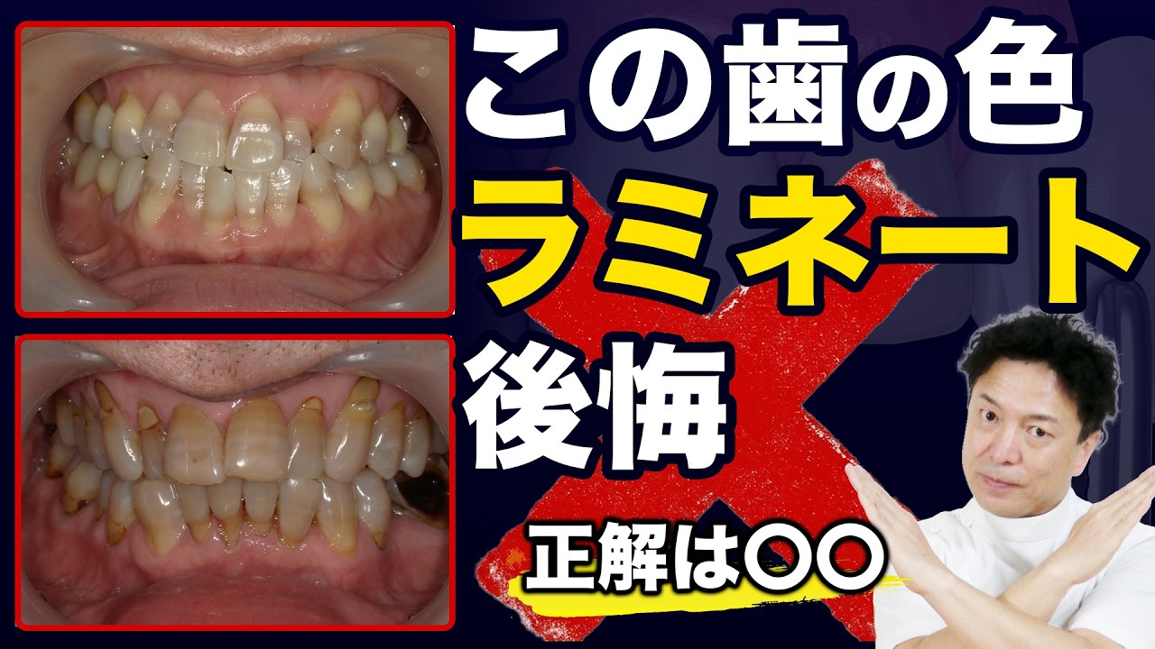 【テトラサイクリン歯】ラミネートは後悔します。専門医が教える本当の正解とは？