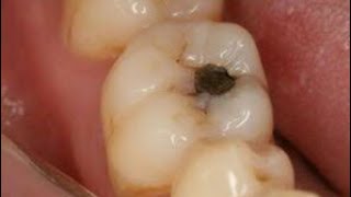 फिटकरी से दांत में लगे कीड़े को बाहर निकाल कर दांत दर्द को ठीक करें | Teeth Pain Home Remedy Hindi