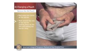 Urostomy: Changing a Pouch