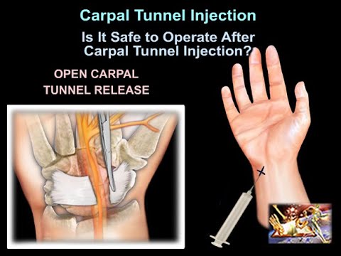 Injection du canal carpien - Tout ce que vous devez savoir - Dr Nabil Ebraheim