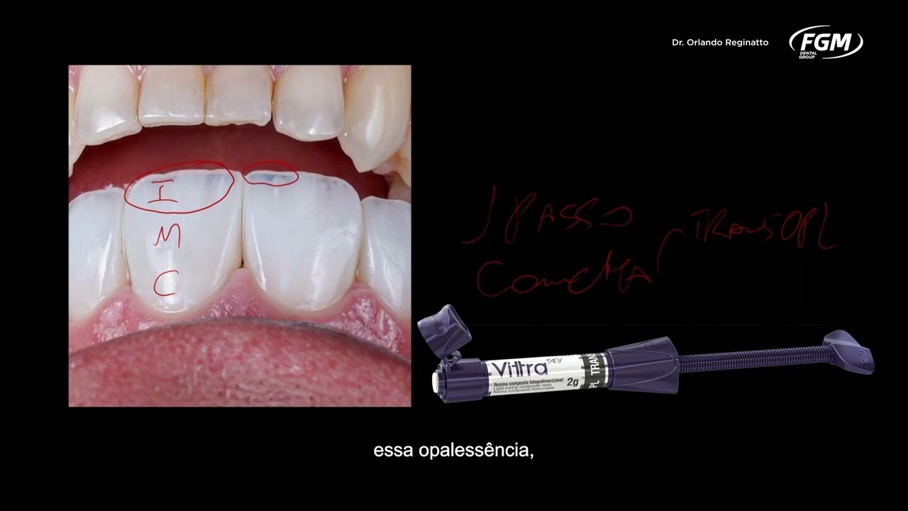 #DicasDeConsultório Estratificação em resina composta com Vittra APS