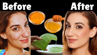 How to Remove Acne, Pimples & Dark Spots Fast Naturally | Get Rid of Acne, Pimples & Dark Spots Fast