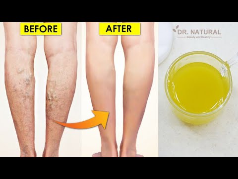 bysption varicoza perico hidrogen din varicoza