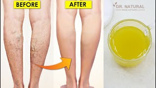 Get rid of Varicose Veins with This Natural Treatment (100% work)