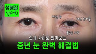 EDITION TV - 전형적인 중년 눈성형 전후 | 노화로 처진 눈꺼풀, 꺼진 눈 자연스럽게 젊어지는 법
