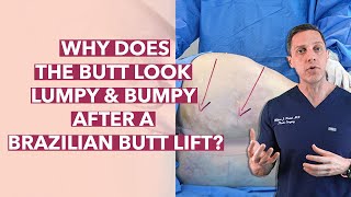 Lumps, Bumps, and Indentations After a BBL. Do They Go Away?