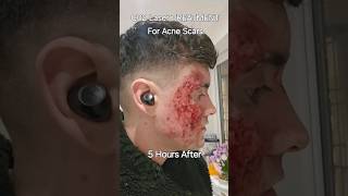 C02 Laser Acne Scars Before VS After