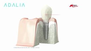 Implantes de Nobel Biocare - Clínica Dental Dra. Elena Adalia