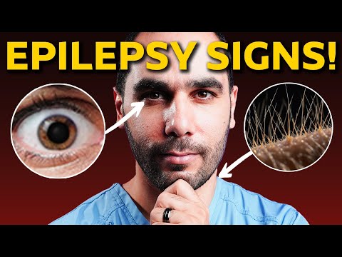 10 Signs You Have Epilepsy Without Knowing