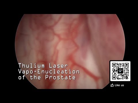 Prostatitis Ár- műveleti lézer