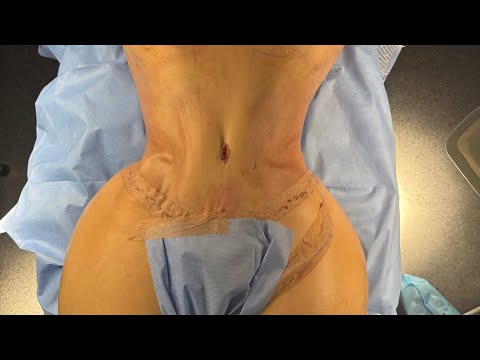 Body Contouring with Dr. Jorge Sandoval: Tummy Tuck, VASER and Lipo