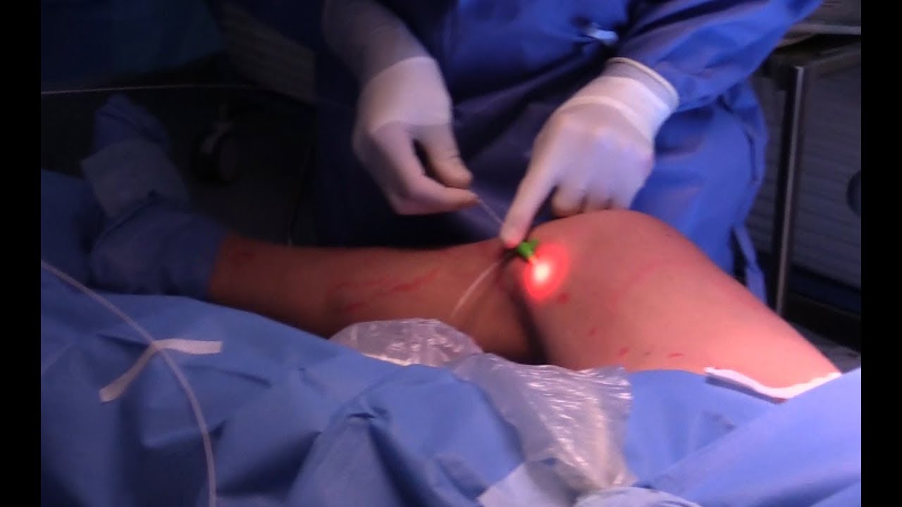 Watch Now Safena: intervento con il laser Safena: intervento con il laser