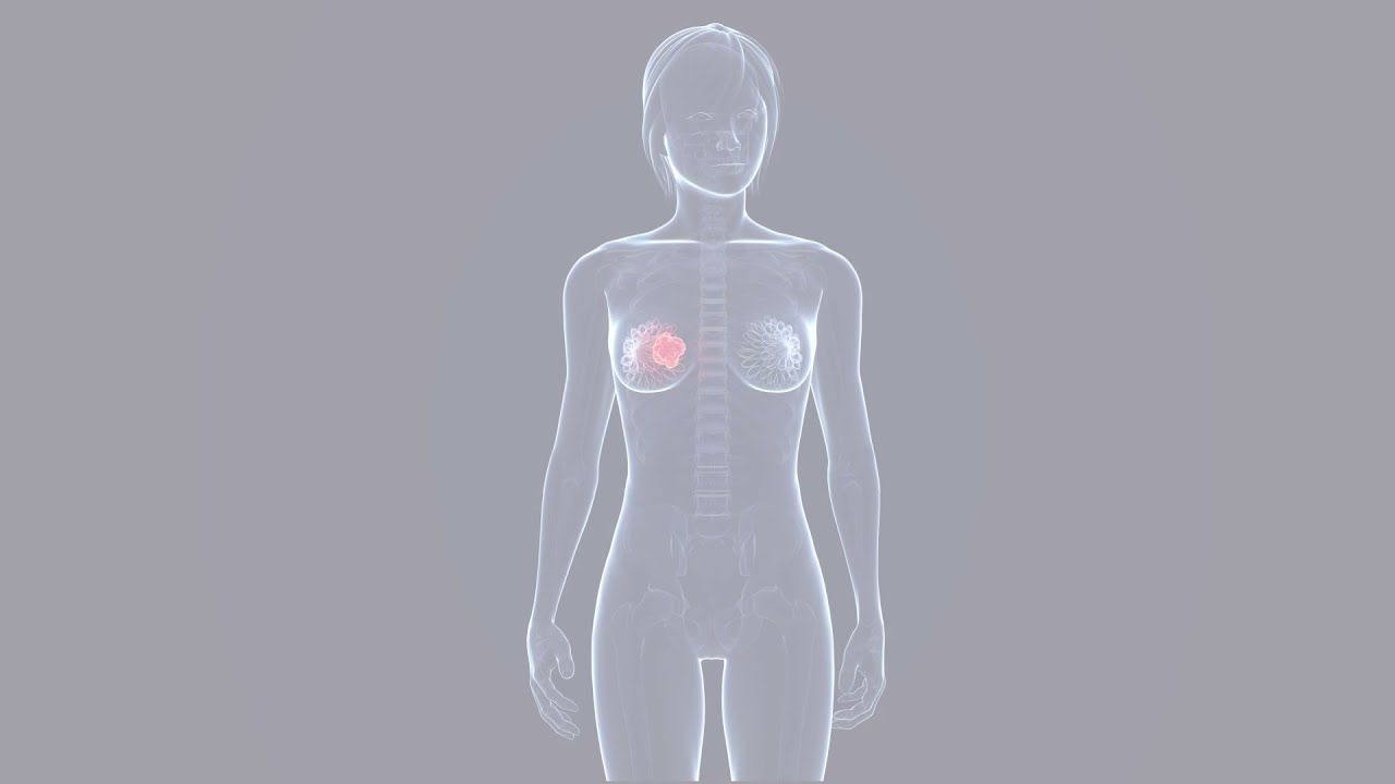 Ncounter Max Ncounter® Breast Cancer 360™ Panel – PEMPAW
