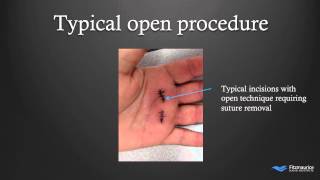 EndoTech® Endoscopic Trigger Finger Release | Fitzmaurice Hand Institute | Phoenix Arizona