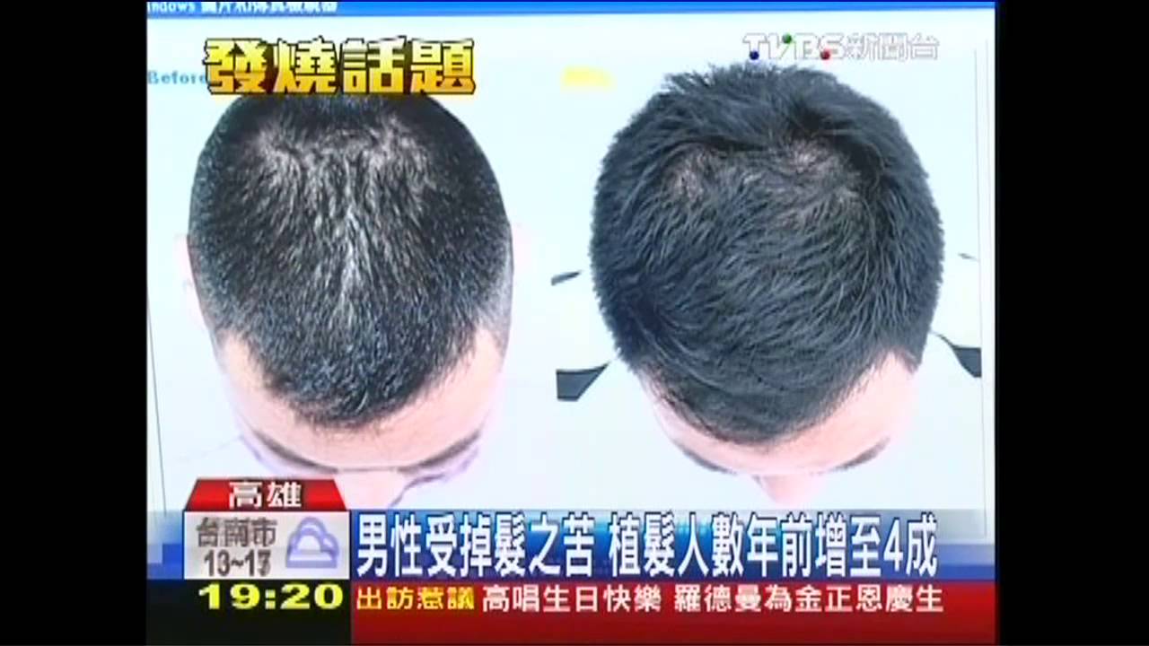 見親友有「面」子 年前微整人數增近3成