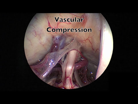 Endoscopic Microvascular Decompression for Trigeminal Neuralgia