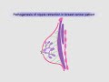 Breast Examination