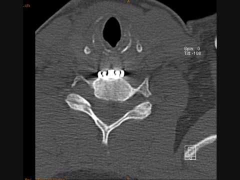 Beim Anheben der Beinschmerzen im Hüftgelenk Klammer für Hüftgelenke
