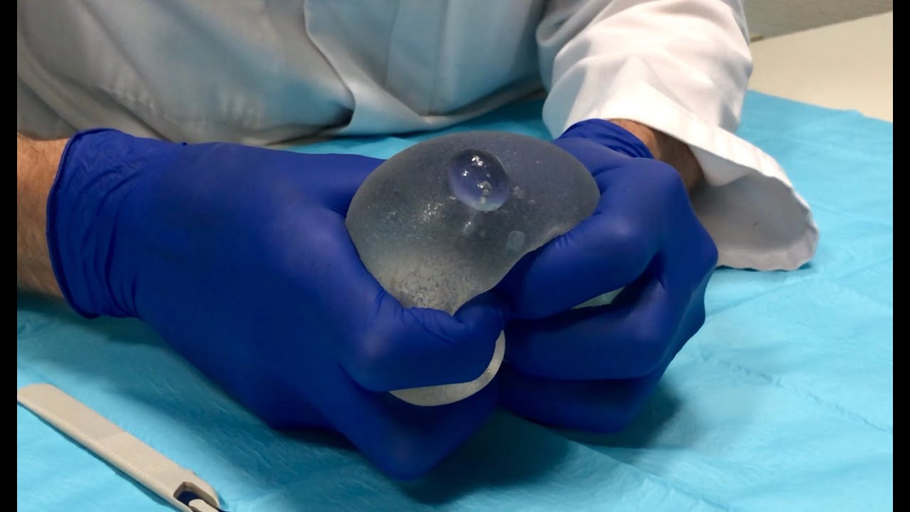 Rupture d'un implant