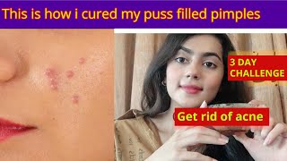 Home remedy to cure puss filled pimples | Get rid of acne | Get rid of puss Pimples