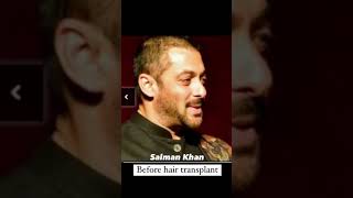 Download lagu Salman Khan Hair Transplant | JOZI | Celebrity Hair Transplant mp3
