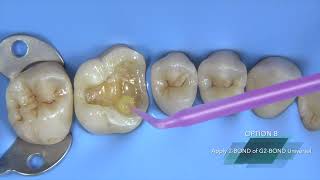 GC Indirect Restorative Solutions - Immediate Dentin Sealing