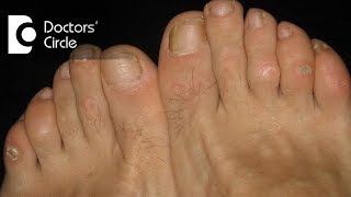What causes itching, scaly lesions in webs of finger and toes?  - Dr. Sudheendra Udbalker