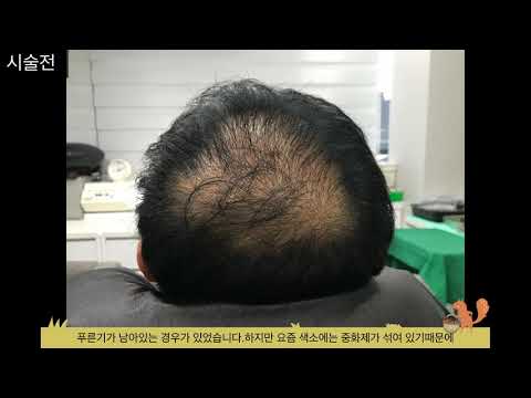 두피문신-두피문신을 하고 시간이 지나면 색이 푸르게 변하나요?