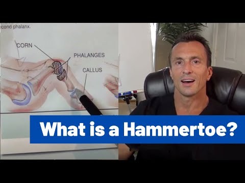 What is a Hammer Toe?