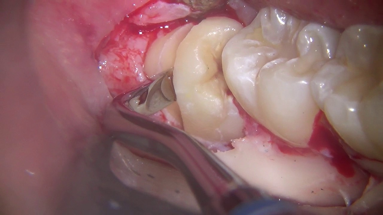 Watch Now Estrazione dente del giudizio inferiore. Lower third molar extraction Estrazione dente del giudizio inferiore. Lower third molar extraction