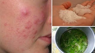 7 Cystic Acne Home Remedies that Really Work