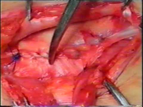 New inguinal hernia repair surgery without mesh-Dr. Desarda Repair