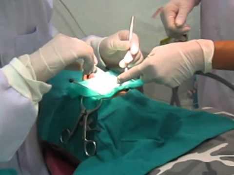 Kata Beach Dental Clinic..Dentist/Phuket... Root Canal Treatment