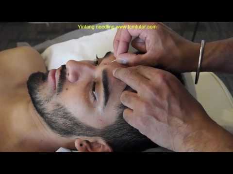 How to needle Yintang (Hall of Impression)