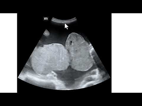 Massas ovarianas sólidas e bilaterais