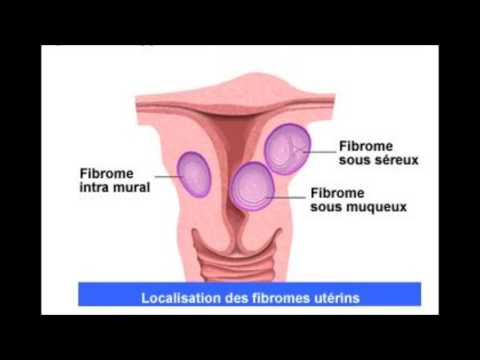 Hypertension problèmes réels Les étapes de diagnostic de lhypertension orthographe correcte
