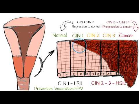 CIN - Cervical intraepithelial neoplasia (cervical dysplasia). CIN I; CIN II; CIN III explained